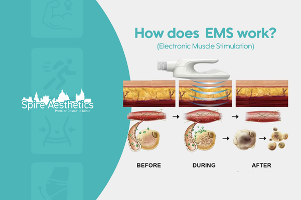 EMS treatment for post pregnancy weight loss treatment Winkfield