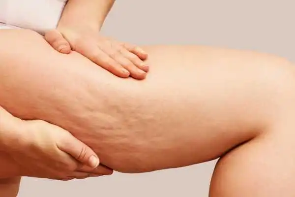 Image of woman showing leg with cellulite Winkfield