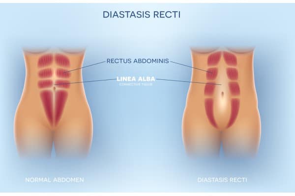 What Non-Surgical Options Are Available for Diastasis Recti Winkfield?