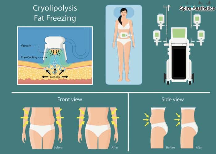 Image of diet and fat freezing combined for best results for Spire Aesthetics Winkfield