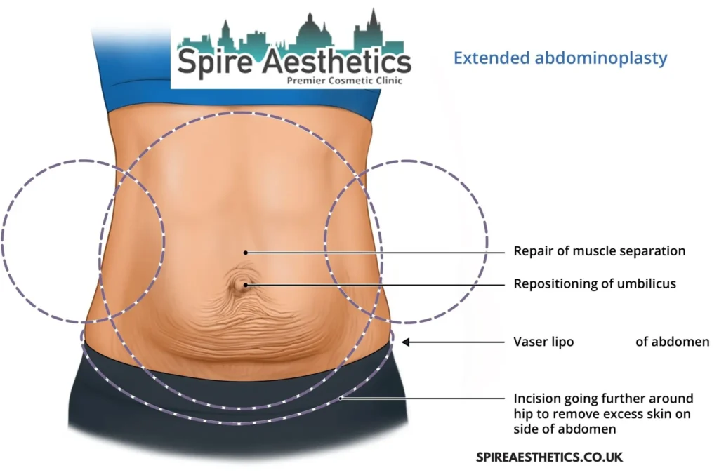Understanding Loose Skin After Gastric Band Winkfield Surgery and HIFU Treatment