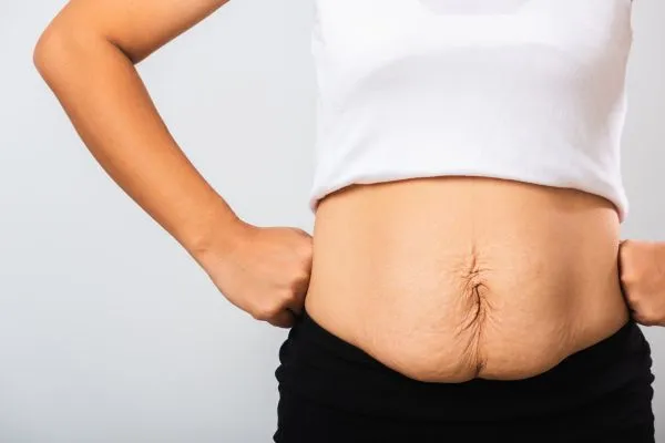 Image of a woman's stomach after weight loss with sagging skin following a gastric band Winkfield
