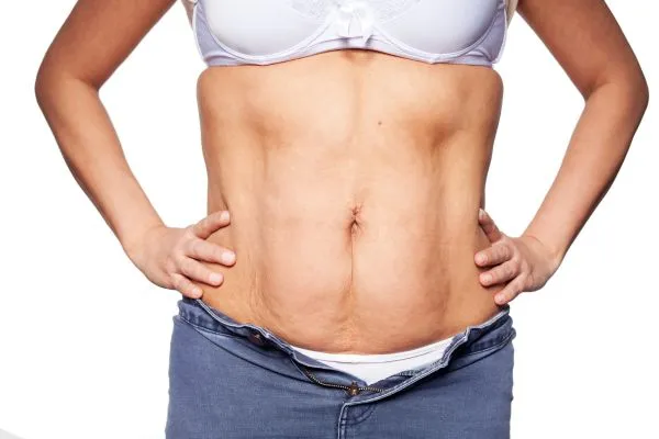 sagging skin on woman's stomach after weight loss injections Winkfield