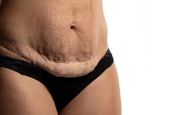 Image of womans stomach after weight loss injections Winkfield showing saggy skin