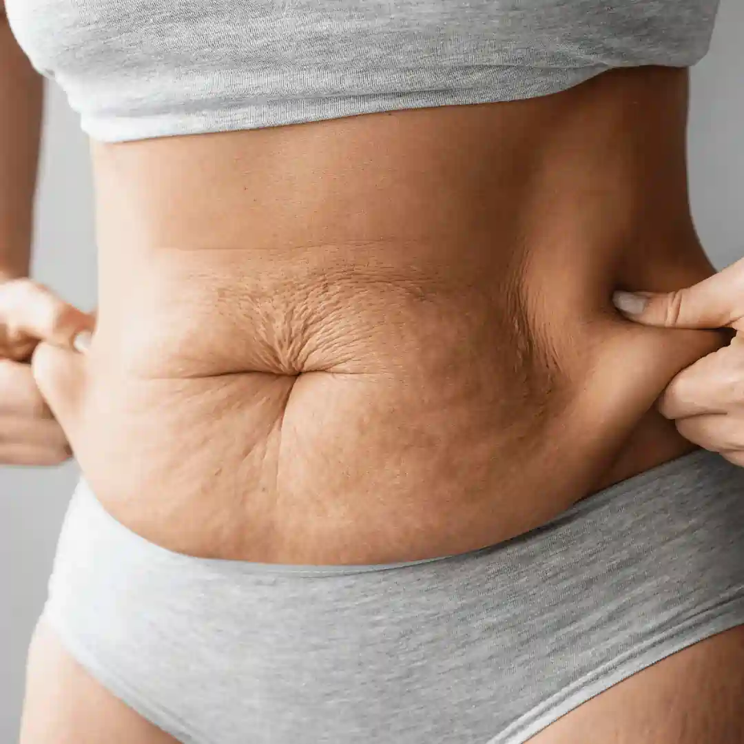 Is It Normal to Have Loose Skin After Pregnancy Winkfield?