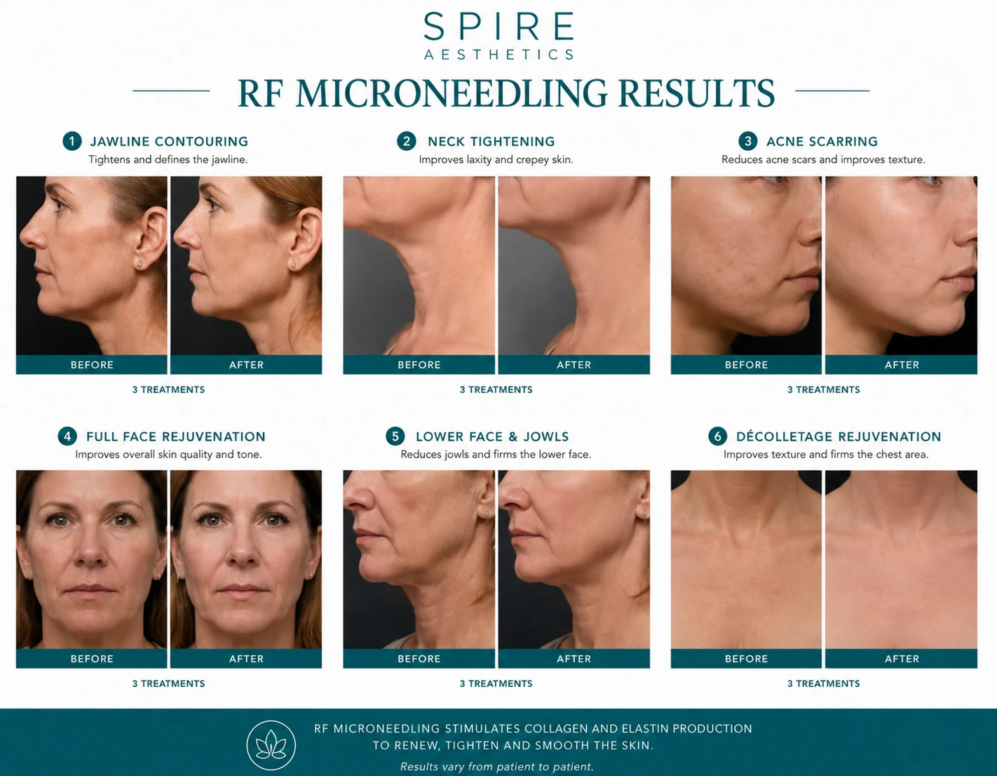RF Microneedling Skin tightening Winkfield results