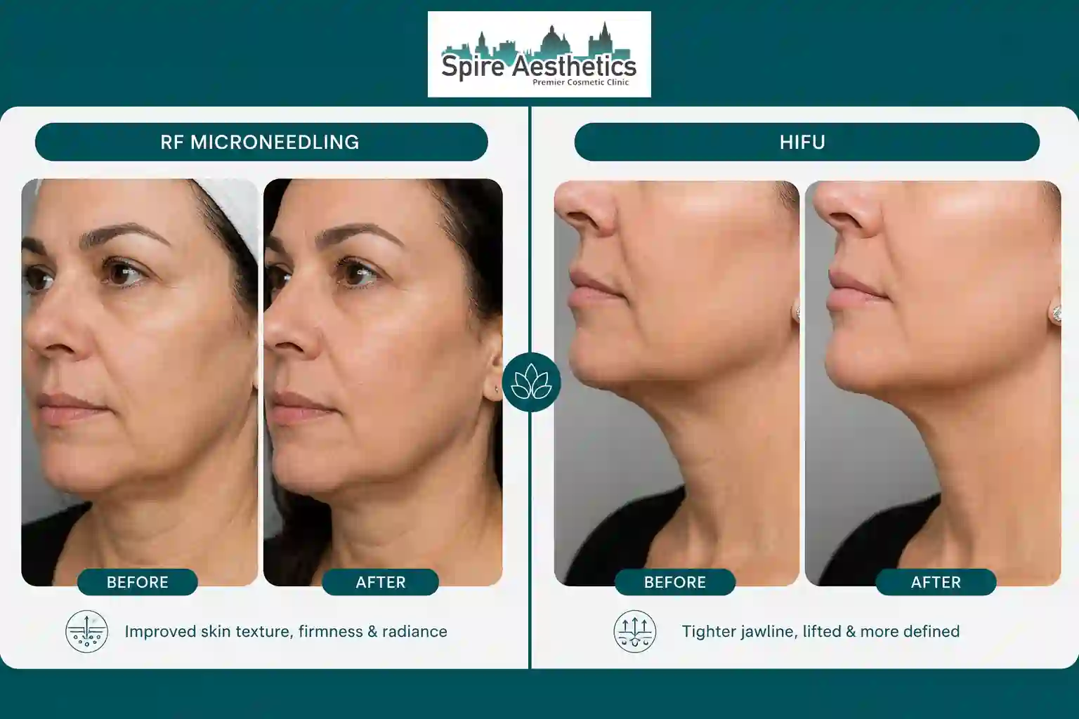 Can RF Microneedling and HIFU Be Combined Winkfield?