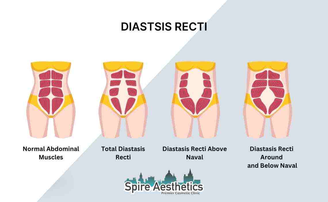 Is Non-Surgical Diastasis Recti Treatment Right for You? Common Concerns Answered Winkfield